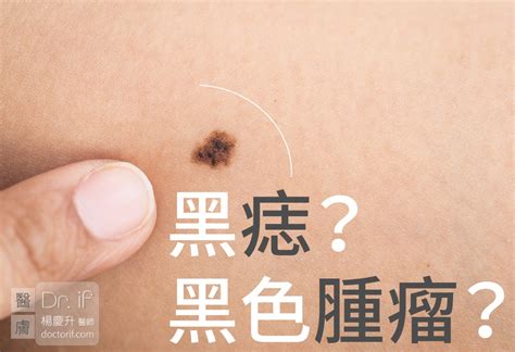 胸部長黑痣|不大驚小怪！如何辨別「黑痣」與「黑色腫瘤」？ 